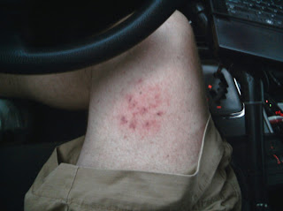 20110524_SoftballHailBruise.jpg